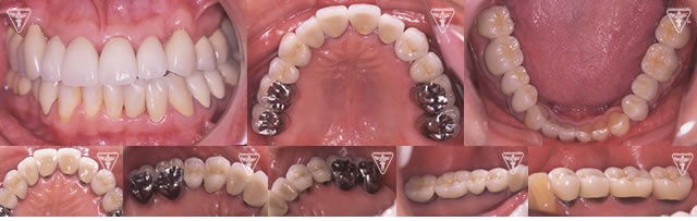 40代 男性 矯正により歯列不正 悪い歯並び を改善したケース 上川歯科医院