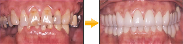 症例②：下顎・奥歯・両側欠損をインプラントで構築した症例