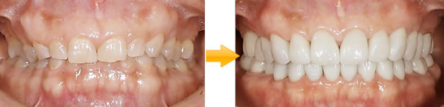 症例②：下顎・奥歯・両側欠損をインプラントで構築した症例