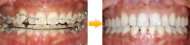 女性：八重歯の矯正治療(ゴムメタル矯正)
