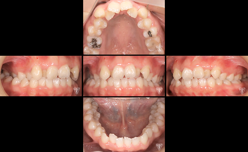 代女性 Angle 級叢生の症例 上川歯科医院